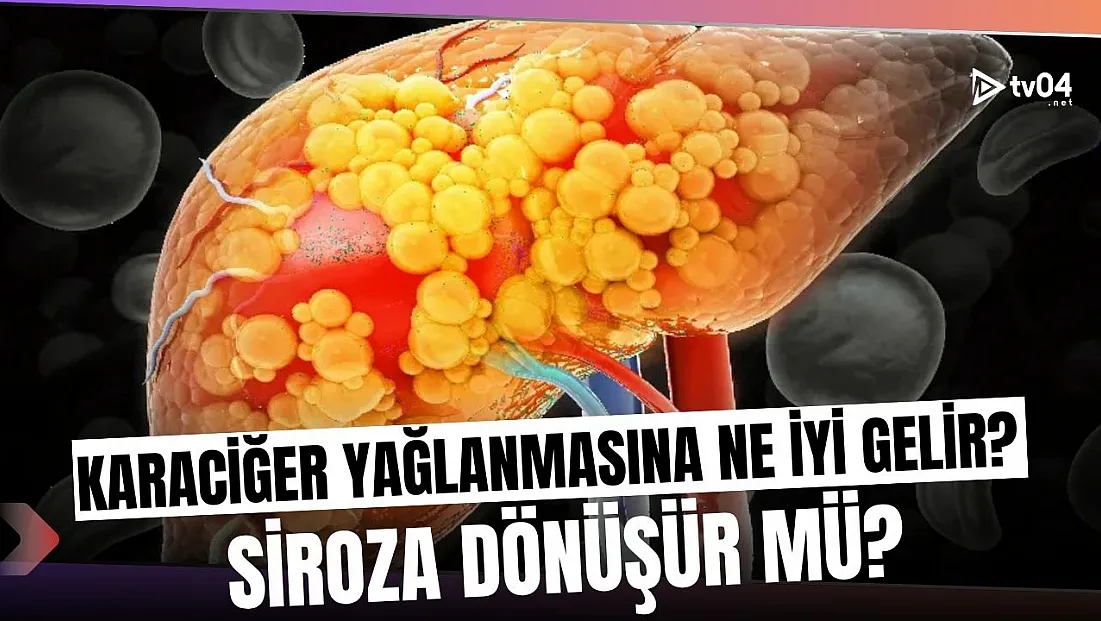 Karaciğer Yağlanması Sessizce İlerliyor: Bu Belirtileri Sakın Görmezden Gelmeyin!